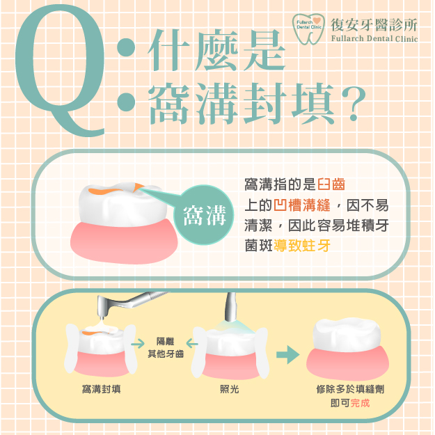 復安 什麼是窩溝封填呢 復安牙醫診所